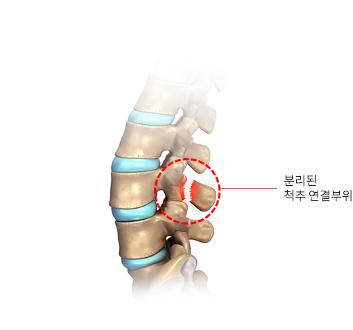 분리된 척추 연결부위