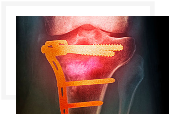근위경골절골술